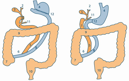 Two variants of biliopancreatic bypass